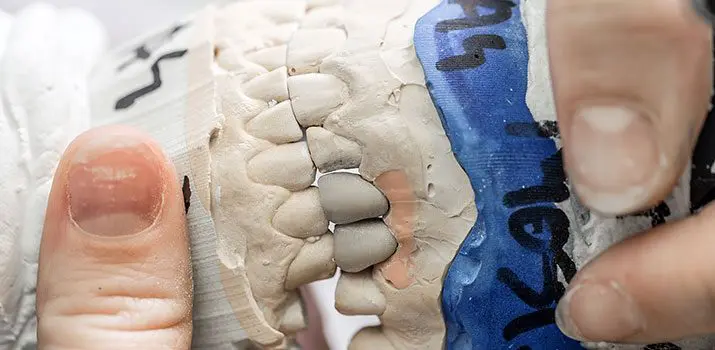 Los tipos de prótesis dentales – Técnico Superior en Prótesis Dentales